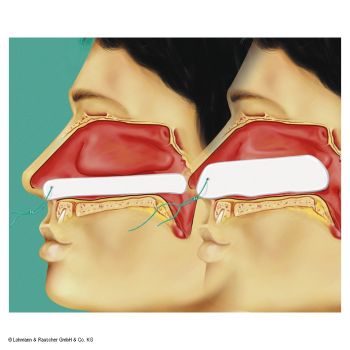 Raucocel-Epistaxistamponaden steril