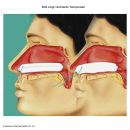 Raucocel Nasentamponaden gerade, ventiliert